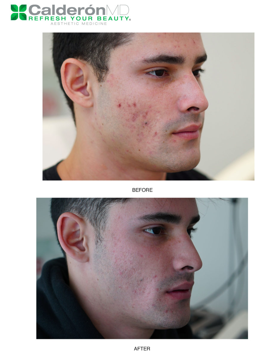 Acne 2_Page_1
