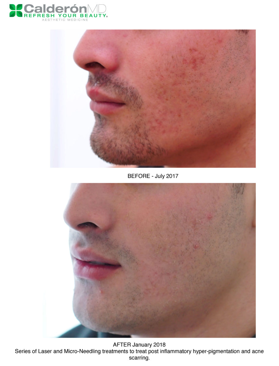 Acne_Page_1